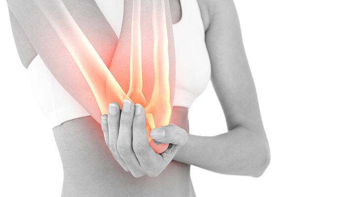 Image graphique montrant une femme tenant son coude fracture olecrane | IK Paris